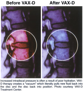 Before and after Vax-D treatment. Increased intradiscal pressure is often a result of poor hydration. VAX-D therapy creates a vacuum which literally pulls new fluid back into the disc and the disc back into position. Photo courtesy VAX-D Treatment Center.